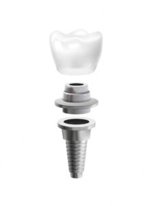 dental implants straumann, medigma, medentica, swiss