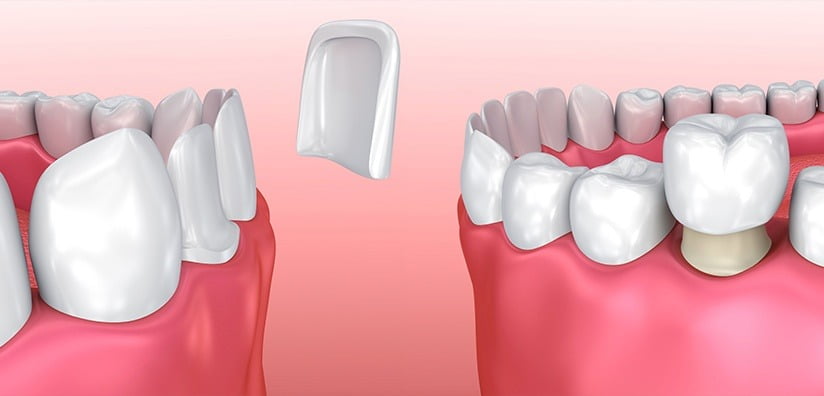 dental crowns vs dental veneers, Couronnes dentaires vs Facettes dentaires