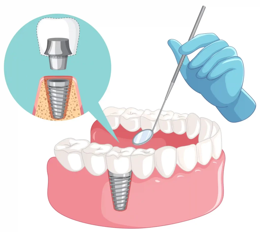 dental implants, implantes dentales